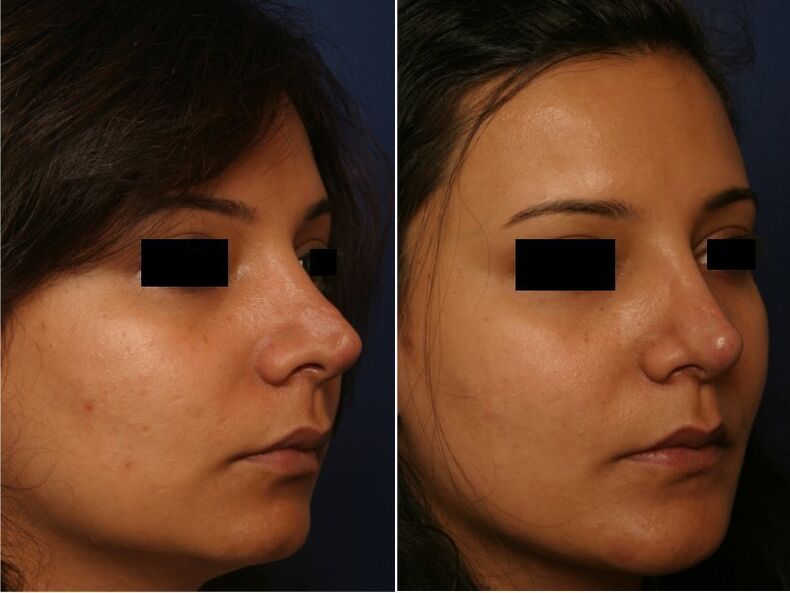 rezultat plastične kirurgije