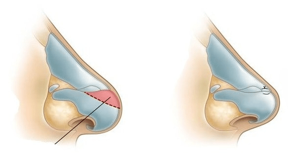 Korekcija oblike nosu