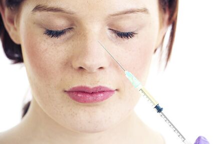 Nekirurška rinoplastika s polnili