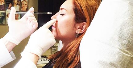 Postopek rinoplastike z uporabo polnil