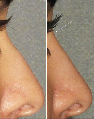 Pred in po nekirurški rinoplastiki