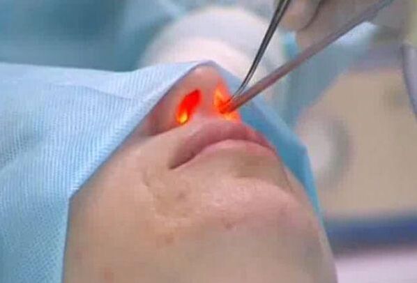 laserska rinoplastika nosu