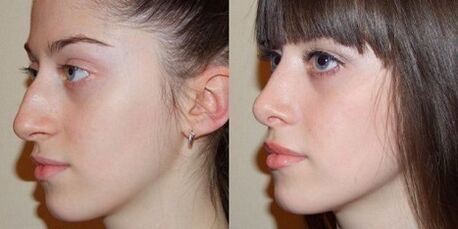 fotografije pred in po rinoplastiki nosu
