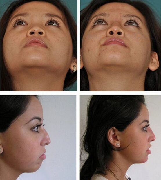 fotografije pred in po rinoplastiki brez operacije