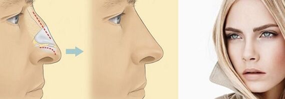 korekcija oblike nosu z nekirurško rinoplastiko