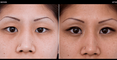 pred in po operaciji očesa