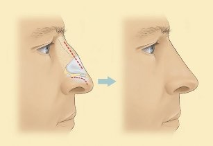 Kako je varčujejo rhinoplasty