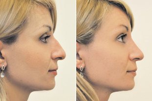 Non-kirurški rhinoplasty pred in po fotografije